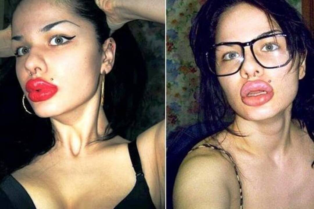Kristina apie savo lūpas: neketinu sustoti jų didinti (foto)