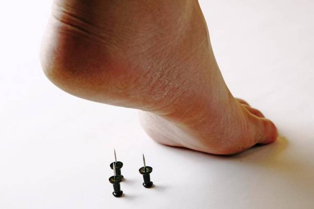 Pirmą kartą medikai aptiko spenelį ant pado (foto)