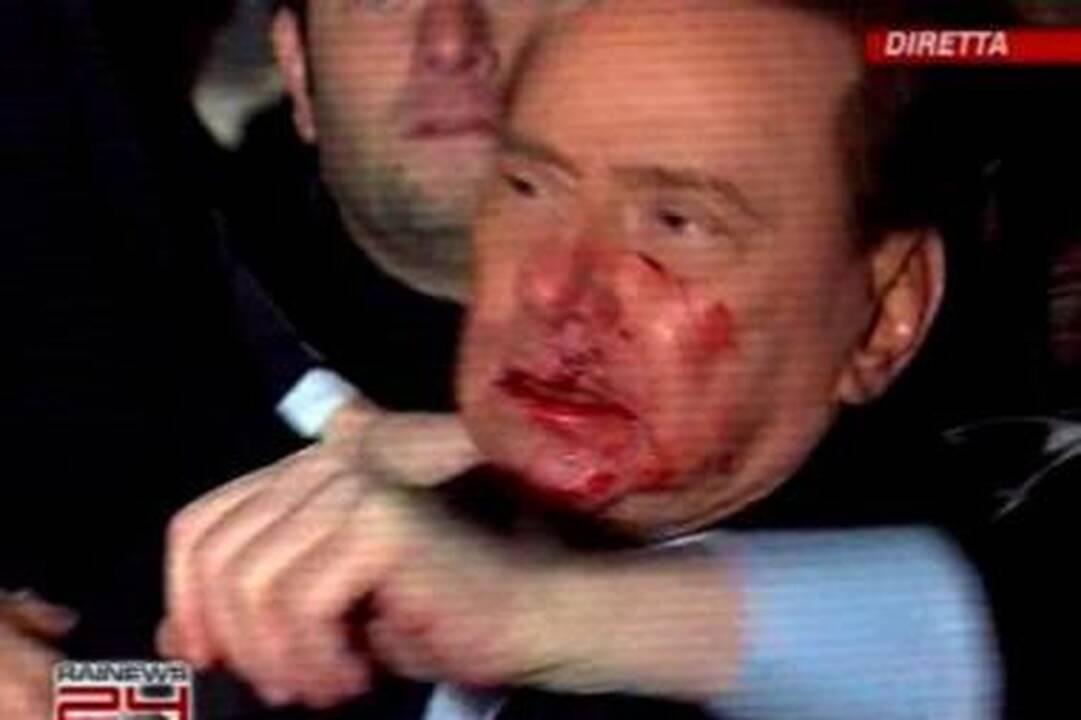 Žala: S.Berlusconi buvo išmušti du dantys, taip pat buvo sužeista viršutinės lūpos vidinė ir išorinė pusė, sumuštas veidas.