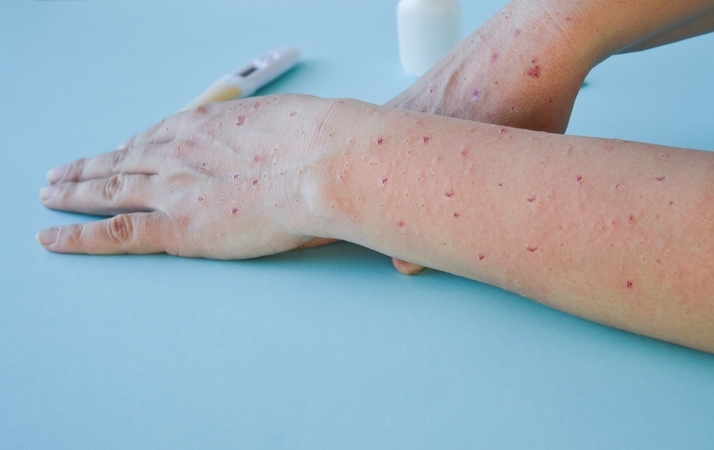 Estijoje nustatytas dar vienas užsikrėtimo beždžionių raupais atvejis