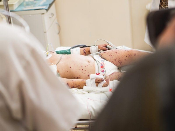 Pirmas šiemet mirties atvejis nuo meningokoko: užgeso kūdikio gyvybė