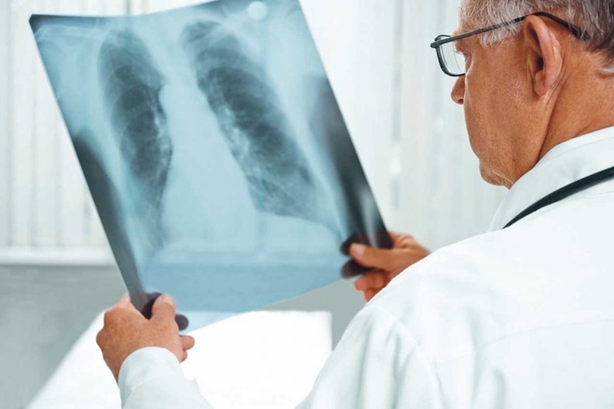 Koronaviruso pandemija sunkina kovą su AIDS ir tuberkulioze