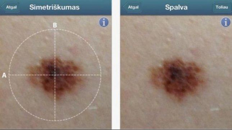 Lietuviška programėlė leidžia stebėti pigmentinių apgamų pakitimus 