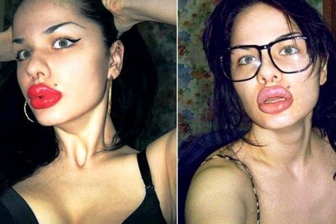 Kristina apie savo lūpas: neketinu sustoti jų didinti (foto)