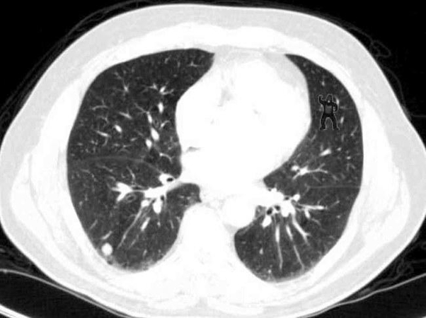 Dauguma patyrusių radiologų rentgeno nuotraukoje nepastebėjo gorilos
